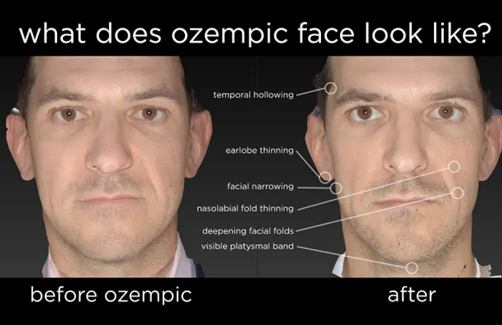 Ozempic Face